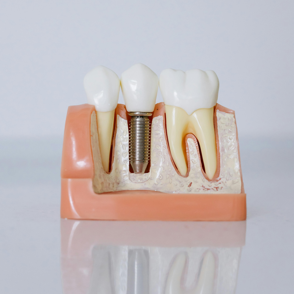 Implantes Dentários